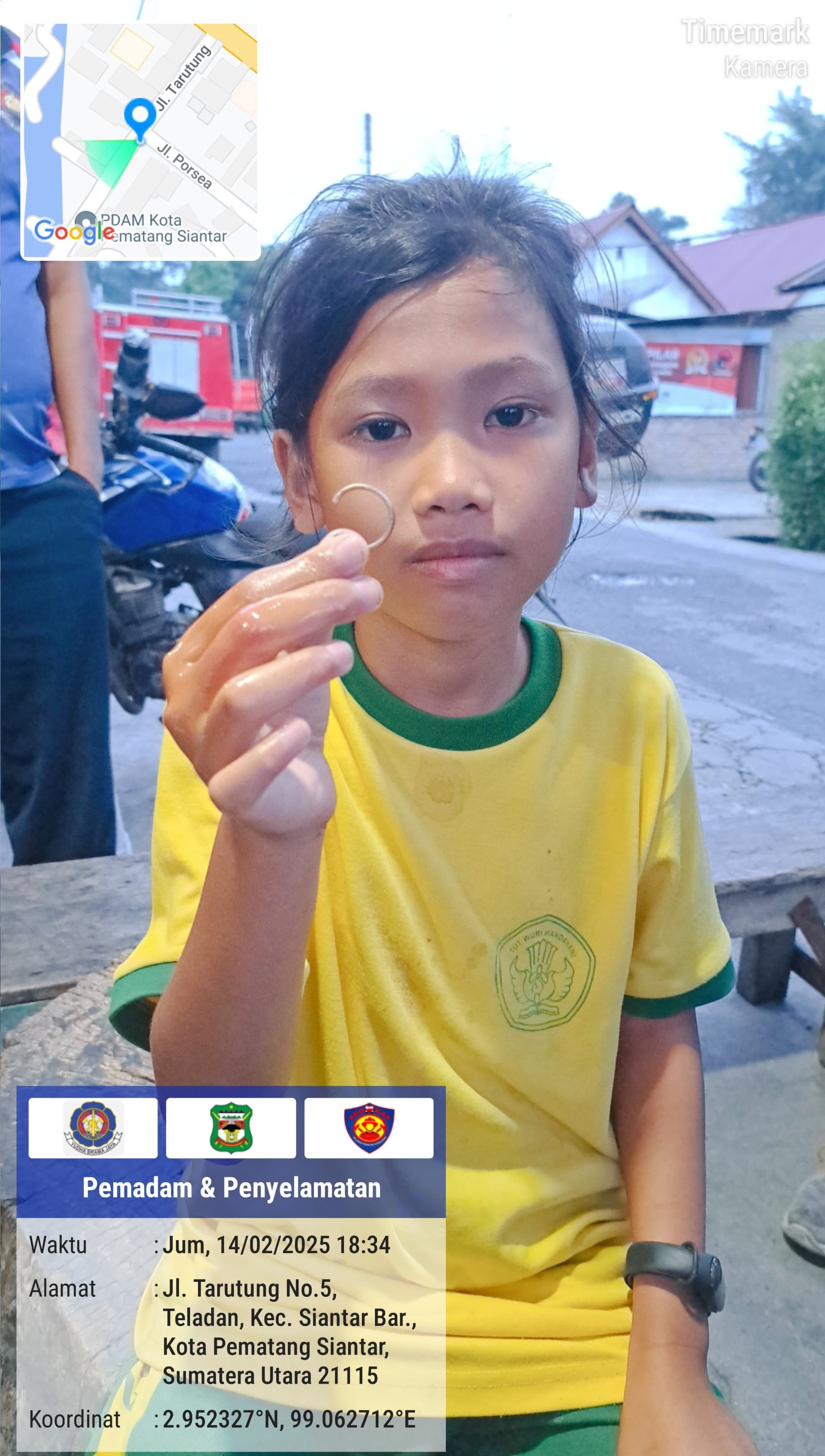 pelepasan cincin dari jari seorang anak yang tidak bisa dilepas