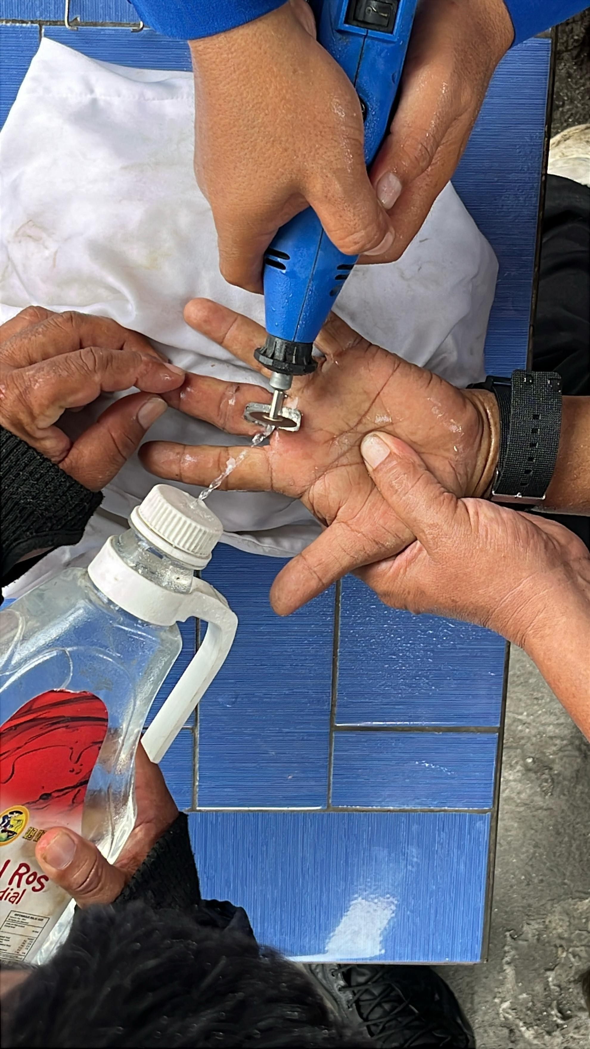 pelepasan cincin dari jari seorang warga