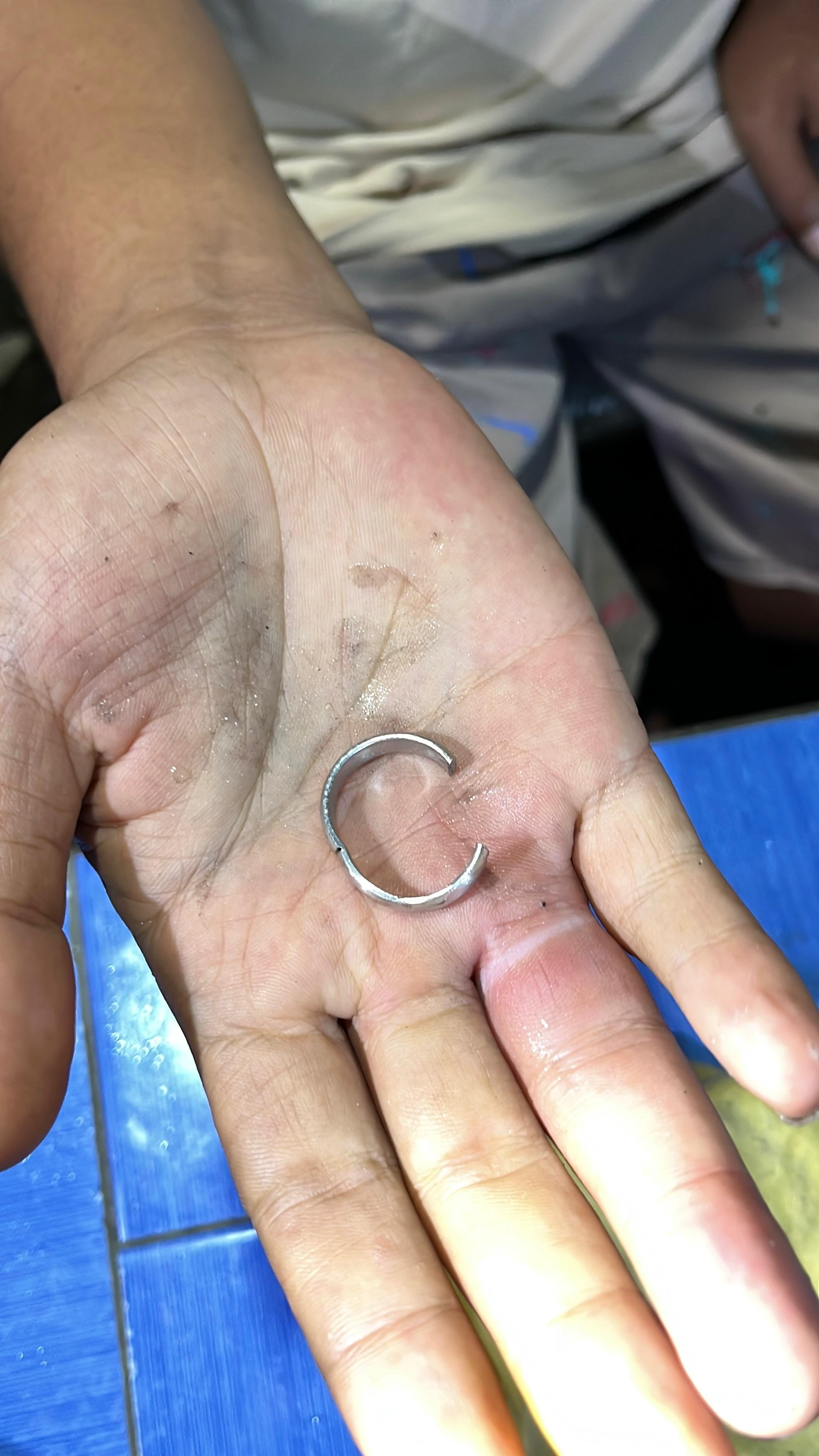 pelepasan cincin dari jari seorang warga yg tidak bisa dilepas yang beralamat di Jl. Perbatasan