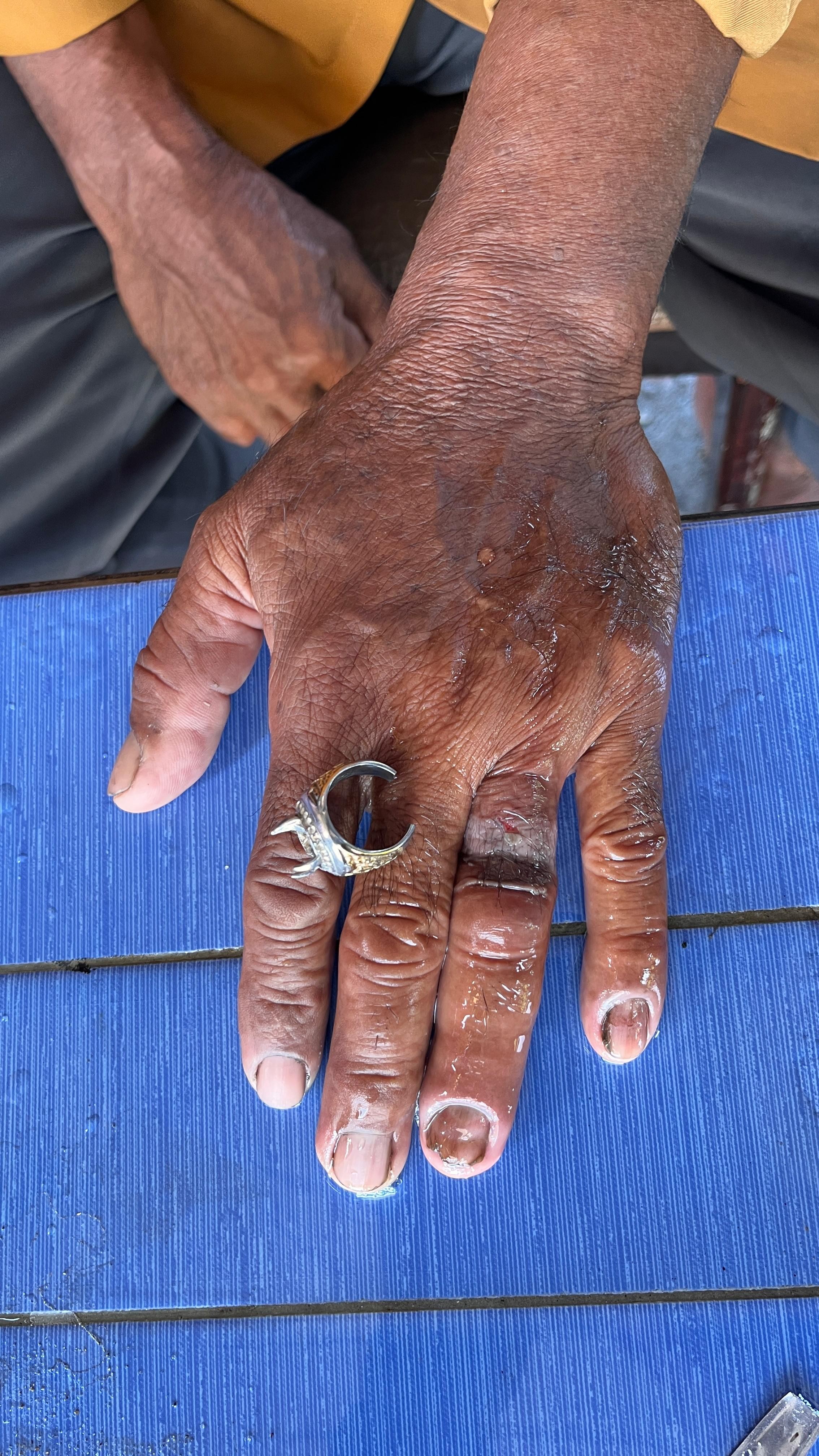 Personil Dinas Pemadam Kebakaran dan Penyelamatan berhasil melaksanakan pelepasan cincin dari jari s